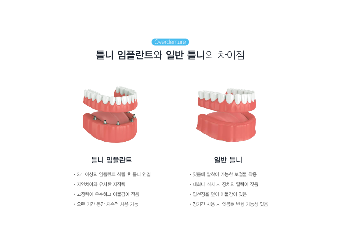 Ʋ�����ö�Ʈ�� �Ϲ�Ʋ���� ������