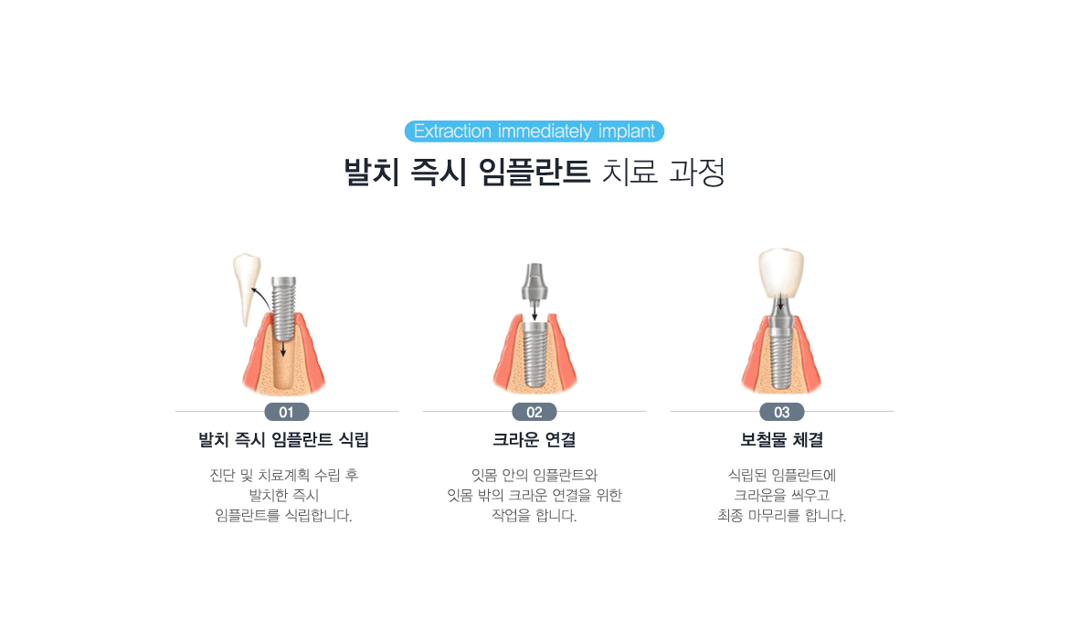 ��ġ ��� ���ö�Ʈ ġ�� ����