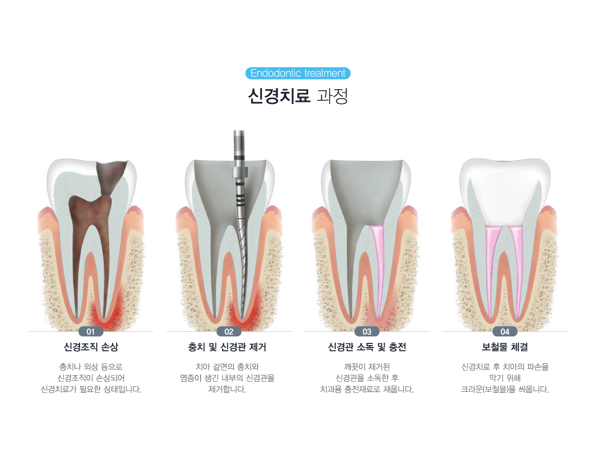 �Ű�ġ�� ����