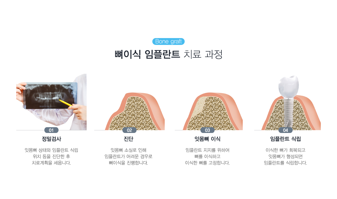 ���̽����ö�Ʈ ġ�� ����